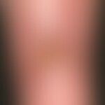 Ulcus cruris arteriosum: chronisches, langsam progredientes, schmerzhaftes, im Bereich des Unters...