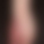 Vascular malformations: Nevus flammeus (capillary/venous malformation) without soft tissue hypert...