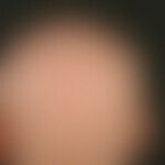 Alopecia areata totalis: complete hair loss except for a few individual hairs; with greater enlar...