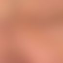 Xanthelasma: die Hautläsionen entwickelten sich allmählich innerhalb der vergangenen 3-4 Jahre. M...