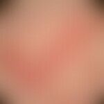 Basalzellkarzinom knotiges (Auflichtmikroskopie): wahrscheinlich seit Jahren bestehende, langsam ...