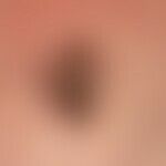 Basalzellkarzinom knotiges: zentral ulzeriertes Basalzellkarzinom. Die Diagnose ist an den randli...