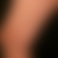 Lichen planus exanthematicu... Lichen planus exanthematicus: for several months persistent, itchy, generalized, dense rash with ...
