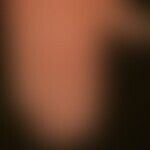 Lichen planus exanthematicus: for several months persistent, itchy, generalized, dense rash with ...