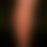 Lichen planus exanthematicus. for 2 months persistent, itchy, generalized, dense itchy rash with ...