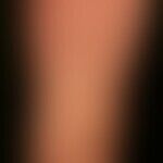 Lichen planus exanthematicus: an itchy, generalized, dense rash with emphasis on the trunk and ex...