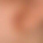 Atopische Dermatitis (impetiginisierte Ohrläppchenrhagade): bei der 10-jährigen Patientin rezidiv...