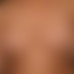 differential diagnosis "scleroderma systemic": diagnosis: generalized cGVHD: general ized, sclero...