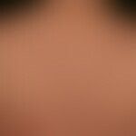 Lupus erythematosus acute-cutaneous: a clinical picture known for several years with a variable c...