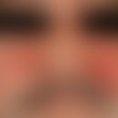 Erysipel akutes: akut aufgetretene, seit 4 Tagen bestehende, zunehmende, glatte, flächenhafte, sc...