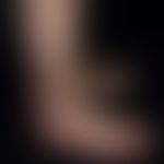 Klippel-Trénaunay syndrome: extensive vascular malformation with extensive nevus flammeus affecti...