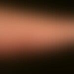 Acute allergic contact dermatitis: acute, itchy, blurred dermatitis of the right forearm that app...