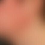 Contact dermatitis allergic: acute, itchy, blurred (marked by arrows), dermatitis. 35-year-old fe...