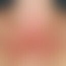 Lichtdermatose polymorphe: akut aufvgetretene Dermatitis wenige Stunden nach erster UV-Bestrahlun...