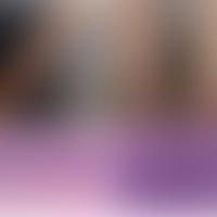 Lymphomatoide Papulose, EBV... Lymphomatoide Papulose, EBV-induzierte: Disseminierte Aussaat kleiner rot-brauner Knoten. Dichtes...
