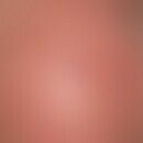 Keratosis actinica, keratotischer Typ: Bei einem 75-jährigen entwickelten sich in den letzten Jah...