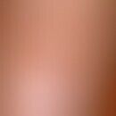 Keratosis seborrhoeic (plaque type): flat, regularly bordered, little pigmented, non-irritant pla...