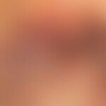 Pemphigus vulgaris: multiple, chronic, since 3 years intermittent formation of large, easily inju...