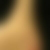 Erythema elevatum diutinum:... Erythema elevatum diutinum: Mann, 67 Jahre. Seit mehreren Jahren zunehmend schmerzlose erythematö...