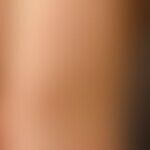Prurigo simplex acuta infantum: Disseminierte,  juckende, stellenweise exkoriierte, Papeln und Bl...