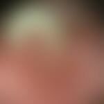 Röhrennagel, stark gewölbte, verdickte Nagelplatte mit Höhlenbildung unterhalb der Nagelplatte

