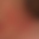 Interstitielle granulomatöse Dermatitis mit Arthritis: rezidivierende unscharf begrenzte erythema...