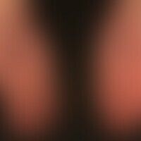 Hyperpigmentierung postinfl... Hyperpigmentierung postinflammatorische: residuale Hyperpigmentierungen nach fixer Arzneimittelre...
