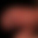Balanoposthitis simplex: chronisch irritative Balanitis bei zirkulärem Lichen sclerosus der Vorha...