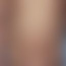 Phrynoderm: multiple, disseminierte, 0,2-0,5 cm große, follikuläre, leicht juckende rötliche Pape...