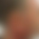 Erythromelanosis follicularis faciei et colli: flächige Pigmentierungen und fixierte Erytheme dur...