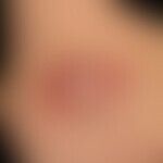 Abszess: fluktuierender schmerzhafter prall-elastischer, schmerzhafter Knoten. Seitlicher Halsber...