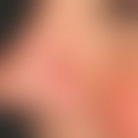 Differenzialdiagnose Basalz... Differenzialdiagnose Basalzellkarzinom knotiges
Diagnose: Keratoakanthom, innerhalb weniger Wo...