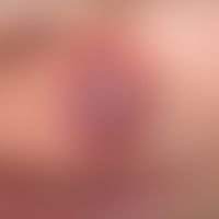 Eosinophiles Granulom der H... Eosinophiles Granulom der Haut: seltene Hautmanifestation; breitbasig aufsitzender, fleischiger u...