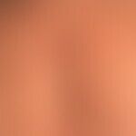 Dermatose, akute febrile neutrophile: rötlich-livide, sukkulente, druckdolente, infiltrierte, sol...