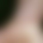Dermatitis, atopische: multiple, chronisch dynamische, unscharf begrenzte, zeitweise juckende, ro...