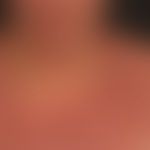 Extrinsische atopische Dermatitis: eminent chronische Ekzembild mit unscharf begrenzten, juckende...