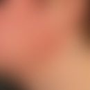 Patch: großflächiges Erythem bei kontaktllergischer Dermatitis
