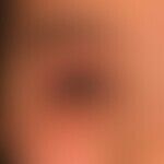 Dermatitis, atopische: chronische, rezidivierende Liddermatitis bei generalisierter atopischer De...