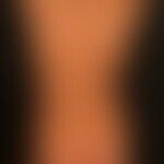 Dermatitis, atopische: generalisierte juckende Dermatitis bei allgemeiner atopischer Diathese.

...