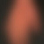 Atopische Dermatitis (Übersicht):  ekzematöser Befall der Handflächen bei generalisierter atopisc...