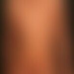 Dermatitis atopische: seit Jahren bestehende, beugeseitig betonte, schwere atopisches Dermatitis....