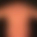 Differenzialdiagnose: Kollagenose reaktive perforierende

Diagnose: Chronische Prurigo
