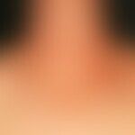 Atopische Dermatitis: chronische, juckende Plaques mit Schuppungen und Verkrustungen bei generali...